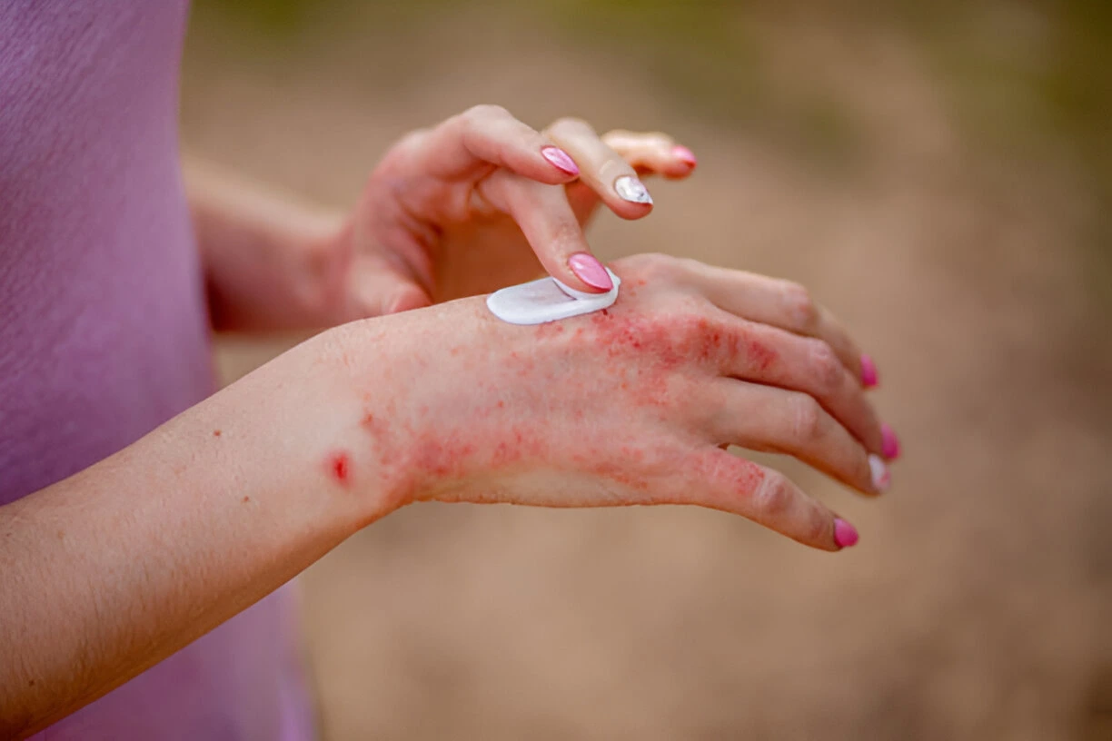 Eczema Symptoms