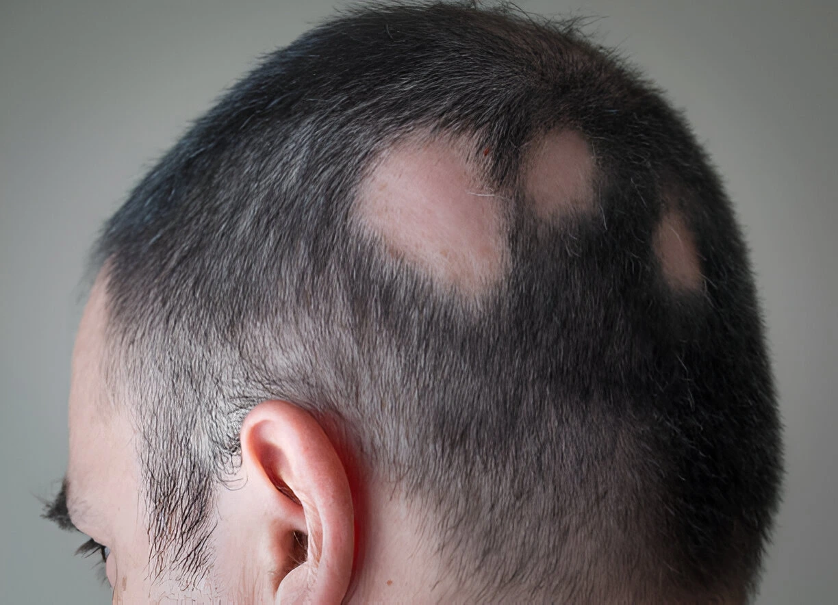 alopecia areata