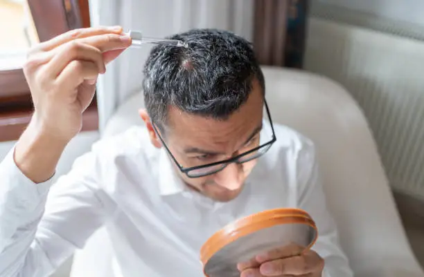 hairfall for hair loss