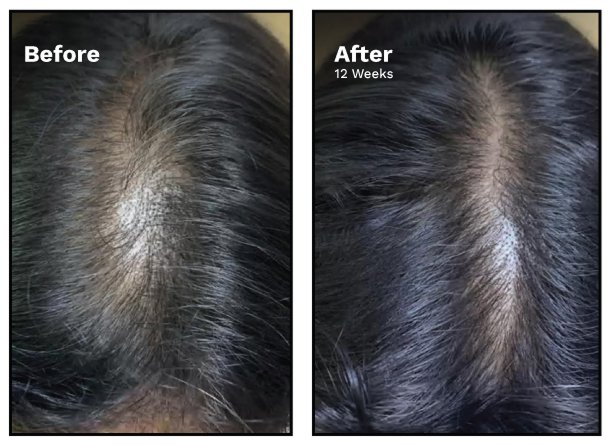 Female Pattern Hair Loss