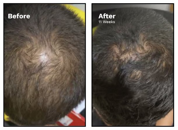 Male Pattern Hair Loss